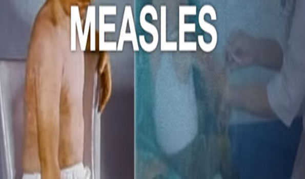 Over 140 measles cases detected in Armenia - Health Ministry