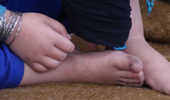 Afghanistan reports spike in measles cases in 2024