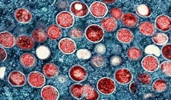 U.S. confirms first case of clade I mpox in California