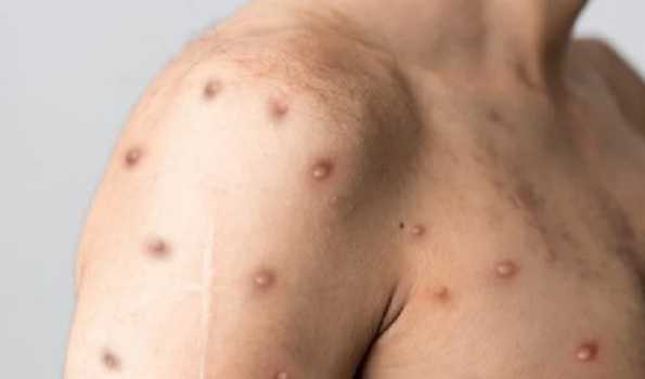 Mpox cases in Africa near 60,000 as 20 countries affected: Africa CDC