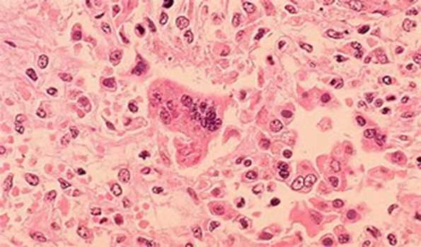 19 children killed in suspected measles outbreak in Nigeria