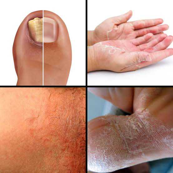 5 Medicines That Help Treat Fungal Infections