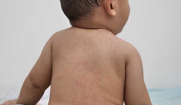 Over 300 measles cases reported in Texas, surpassing 2024 U.S. total