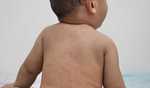 Over 300 measles cases reported in Texas, surpassing 2024 U S  total