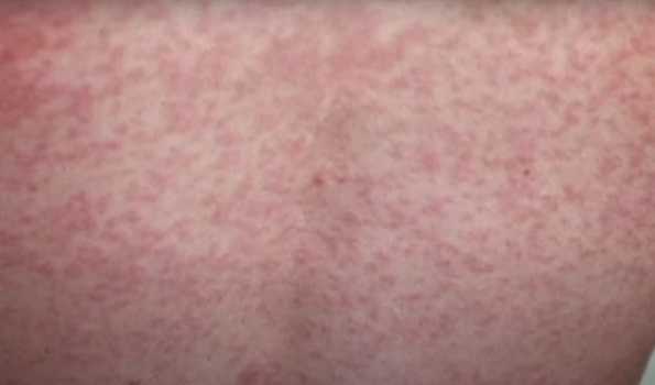Measles health alert issued for Australian state of Victoria