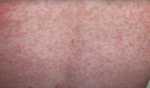 Measles