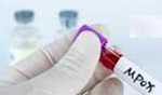 Mpox death toll in Africa surpasses 1,750 since 2024: Africa CDC