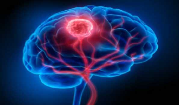 Exposure to dirty air linked to increased risk of common brain tumor: Study