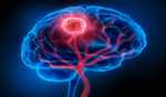 Exposure to dirty air linked to increased risk of common brain tumor: Study